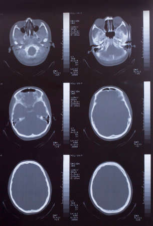 Closeup of a CT scan with brain - Stock Image - Everypixel