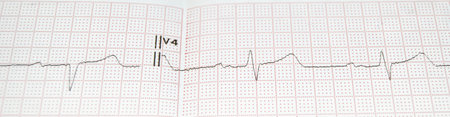 Heart rate on paper for recording an electrocardiogram, prevention of heart diseasesの写真素材