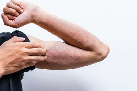 Close up dermatitis on man hand, allergic rash dermatitis eczema skin of a patient. Atopic dermatitis symptom skin detail texture, Fungus of skin. The concept of dermatology.の写真素材