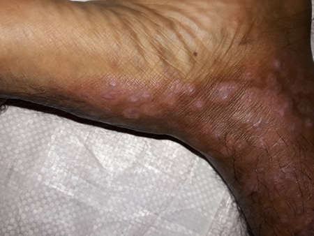 Very  Painful  and  very  bad  skin  disease  on  men's  left  side  leg  .