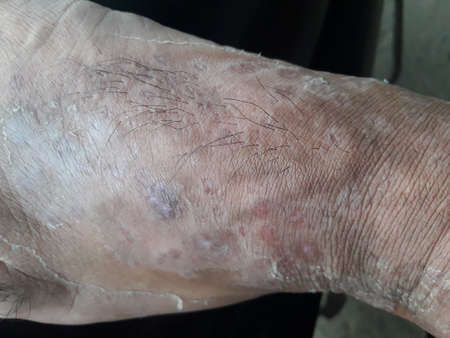 Very bad and very Painful skin disease and infection on men's left side leg.