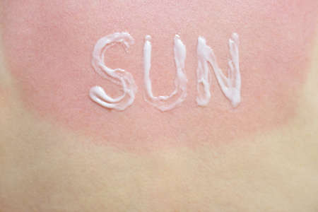 Red skin after a sunburn and the word sun from sunblockの写真素材
