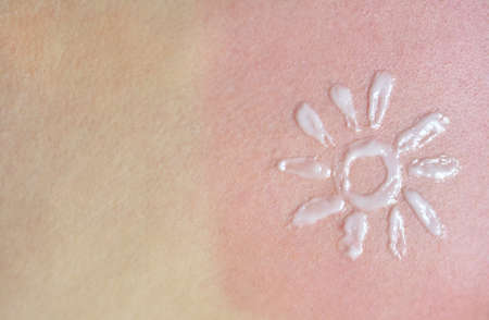 Sunburn and red skin on a female back with a painted sun from a sunblockの写真素材