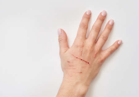 Female hand with cat scratchesの写真素材