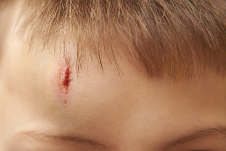 A bump with an open wound on the forehead with pink edgesの写真素材