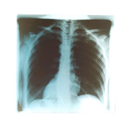lungs radiogram