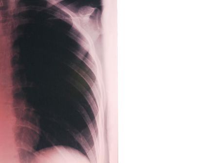lungs radiogram