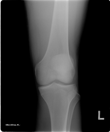 knee tomographyの写真素材