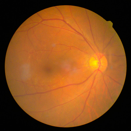 retinalの写真素材