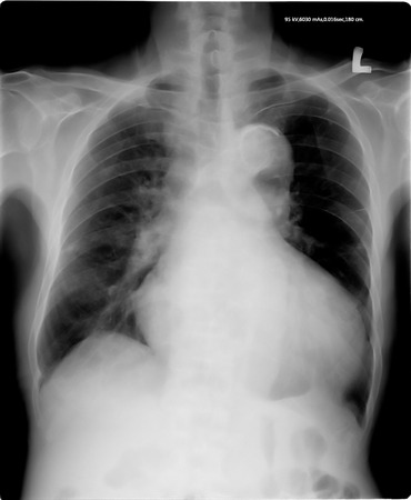 chest x-rayの写真素材