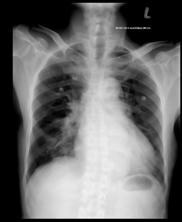 chest x-rayの写真素材