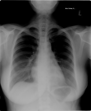 chest x-rayの写真素材