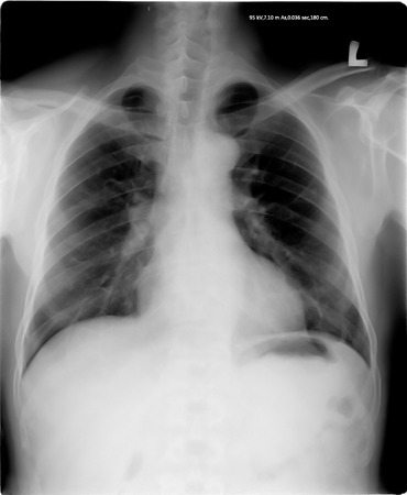 chest x-rayの写真素材
