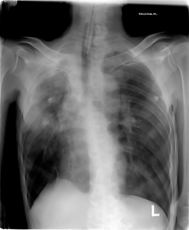 chest x-rayの写真素材