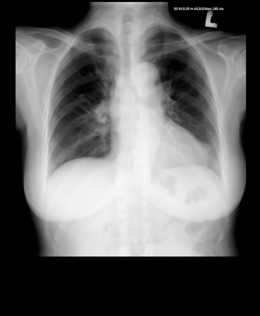 chest x-rayの写真素材