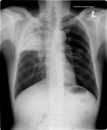 chest x-rayの写真素材