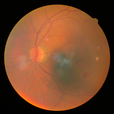 retinalの写真素材