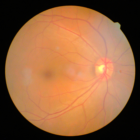 retinalの写真素材