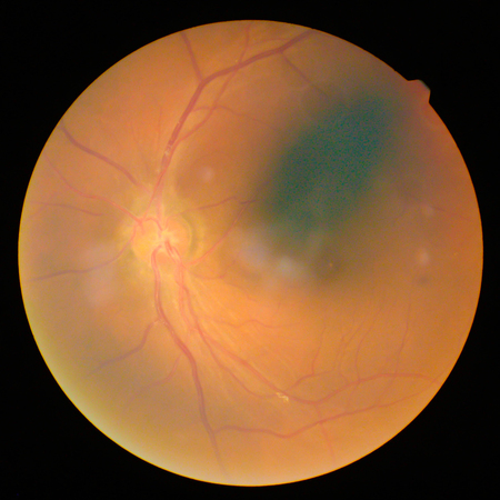 retinalの写真素材