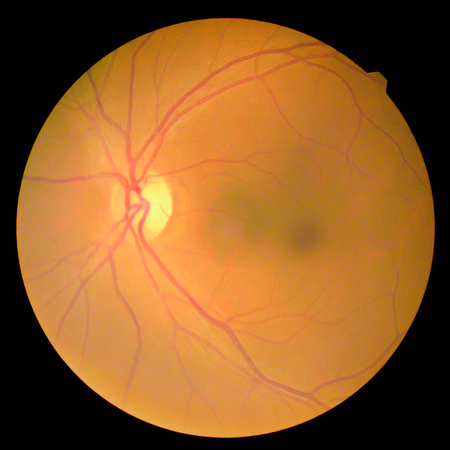 retinalの写真素材