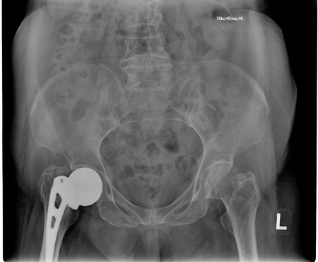 pelvis x-rayの写真素材