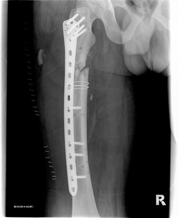 femur tomographyの写真素材