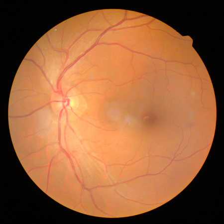 retinalの写真素材