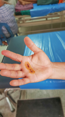 Nurses are washing the wound and stitched the wound from the operation at hand.の写真素材