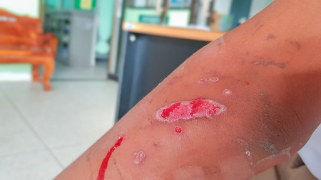 Patients with ulcers, abrasions, motorcycle accident, upside down.の写真素材