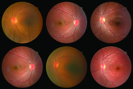 collection of Retinal image  of the patient taken with retinal photography machine.の写真素材