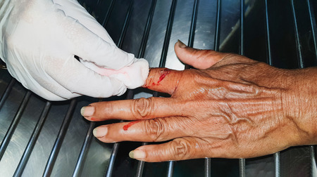 Nurse washing the wound caused by the cat bite  patient  right fingers    and get vaccinated against...