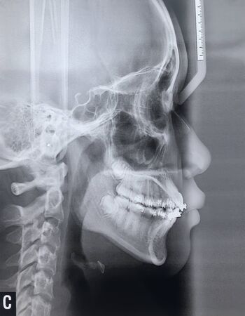 Blurred images and noise of Dental x-ray images of girls aged 14 years to detect abnormalities of the teeth.の写真素材