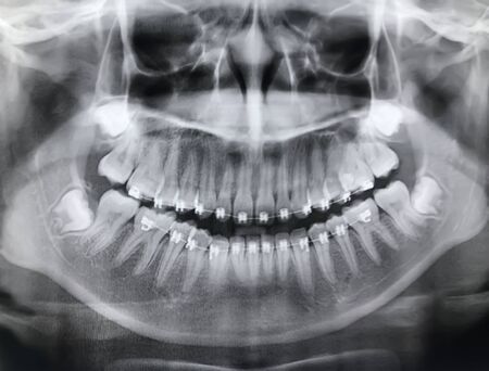 Blurred images and noise of Dental x-ray images of girls aged 14 years to detect abnormalities of the teeth.の写真素材