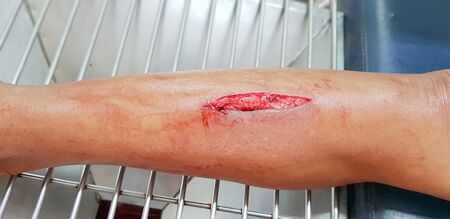Hospital staff treating the patient by injection, clean the wound and stitches to patients. at Health Promoting Hospital District. The patient's injuries were cuts.の写真素材