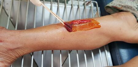 Hospital staff treating the patient by injection, clean the wound and stitches to patients. at Health Promoting Hospital District. The patient's injuries were cuts.の写真素材
