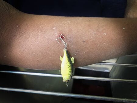 The man's right leg wound caused by fishing hooks. While out fishing At night