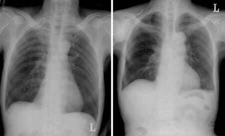 collection of Chest tomography,X-ray of a human to find the disorder of the lungs. Photo tomography pulmonary tuberculosis patients.の写真素材