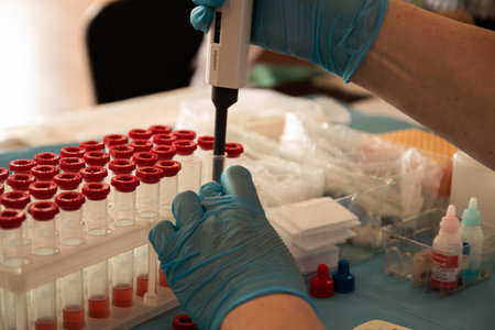 donor's day. a nurse in blue latex gloves takes a blood sample from a patient. medical blood jars....
