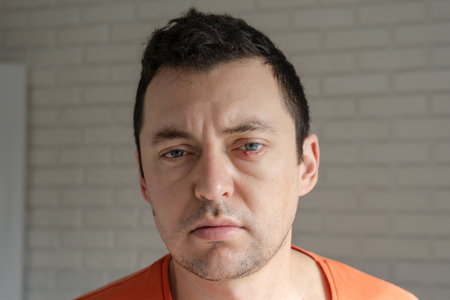 Man with infected chalazion (stye, barley) eye on a lower eyelidの写真素材