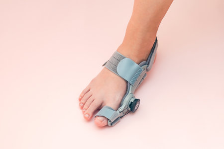 Hallux valgus orthopedic medical thumb brace with adjustment on a female foot