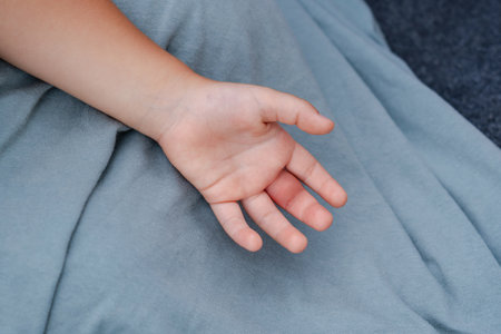 Children hand swollen from wasp sting, insect, a reaction to poisonの写真素材