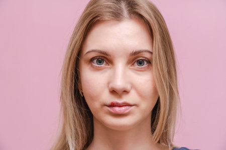 A Closeup on virus herpes on lip of young woman with pink background. Herpes blisters