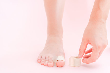 Close up of foot with Valgus Big Bunion toe corrector. Orthopedic silicone support