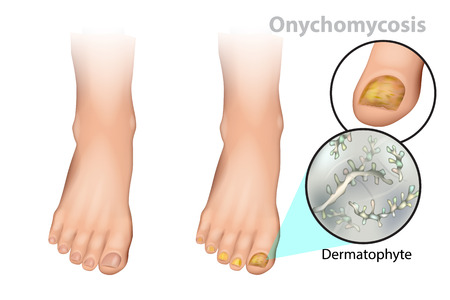 Onychomycosis or tinea unguium. Fungal nail infection. Dermatophyteのイラスト素材