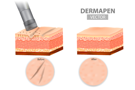 DERMAPEN. Microneedle stamping device. Skin before and after application Collagen induction therapy. Vector illustrationのイラスト素材