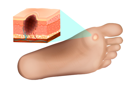 Cross section of a common wart. Anatomy Wart on Foot.のイラスト素材