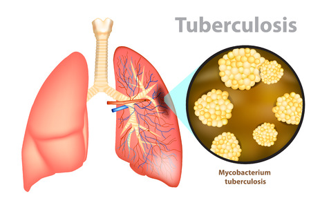 Tuberculosis is an infectious disease caused by the bacterium Mycobacterium tuberculosis.のイラスト素材