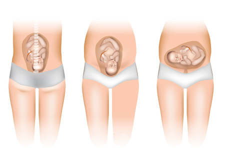 Pregnancy - Different Positions of Baby in the Womb. Fetus Positions In Uterusのイラスト素材
