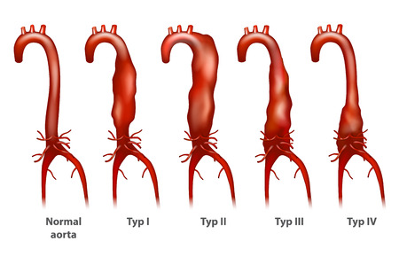 Abdominal aortic aneurysm (Thoracoabdominal). Crawford classification.のイラスト素材