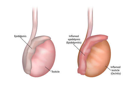 Illustration of the testicle and epididymis. Epididymitis (Inflamed epididymis) And Orchitisのイラスト素材